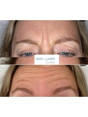 Treatment for Wrinkles - Skin & Laser Clinic