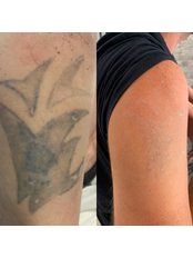 Tattoo removal near completion - Skintastic Aesthetics LTD