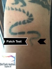 Laser Tattoo Removal Patch Test - Skintastic Aesthetics LTD