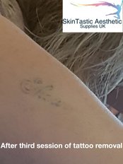 Laser Tattoo Removal Results After Third Session - Skintastic Aesthetics LTD