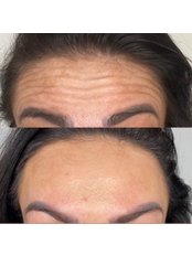 Treatment for Wrinkles - Forever Skin - Cedars
