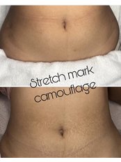 Stretch Mark - Suki Su Permanent Natural Makeup