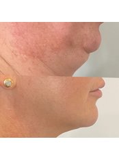 Fat Reduction Injections - Facial Aesthetics London