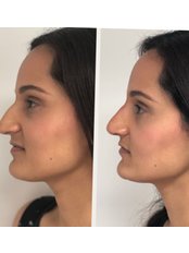 Non-Surgical Nose Job - Facial Aesthetics London