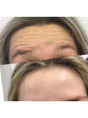 Treatment for Wrinkles - Facial Aesthetics London