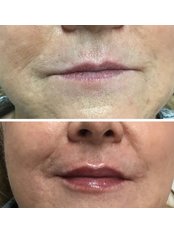 Lip Augmentation - The Skin to Love Clinic