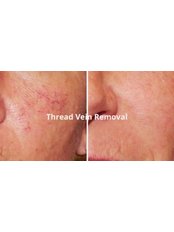 Facial Thread Veins Treatment - The Mobile Laser Clinic