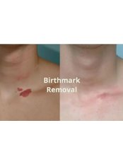 Birthmark Removal - The Mobile Laser Clinic