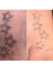 Tattoo Removal - The Mobile Laser Clinic