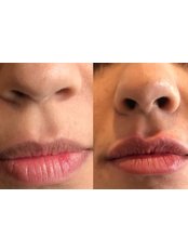 Lip Augmentation - Face & Skin - Welwyn Garden City