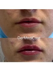 Lip Augmentation - DerMediCare