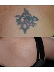 Tattoo Removal - Highland Laser Clinic