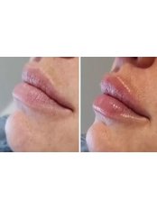 Lip Augmentation 0.5ml - Helen's Aesthetics