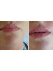Lip Augmentation 0.5ml - Helen's Aesthetics