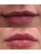 Lip filler - Juvedermm ultra Smile - Dr Vas