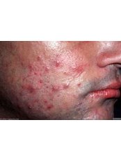Acne Treatment - Canterbury Skin and Laser Clinic