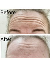 Treatment for Wrinkles - Fabvisage Asethetics
