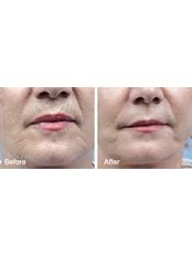 Radiofrequency Skin Tightening - Kent Facial Practice Canterbury Clinic