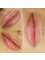 RK Exquisite - Lips - Dermal Fillers 