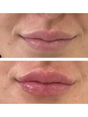 Lip Augmentation - The Skin Clinic Faversham
