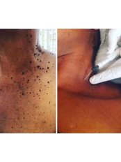 Skin Tag Removal - Adexcel Aesthetics and Travel Health Clinic