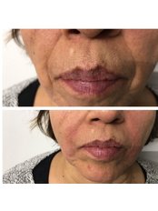 Dermal Fillers- 1ml - Adexcel Aesthetics and Travel Health Clinic