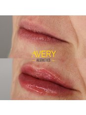 Lip Augmentation - Avery Aesthetics