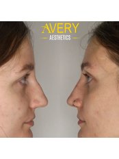 Non-Surgical Nose Job - Avery Aesthetics