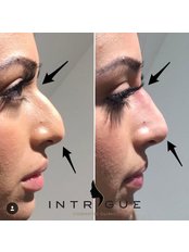 Non-Surgical Nose Job - Intrigue Cosmetic Clinic