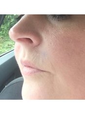 Nasolabial Folds Treatment - Intrigue Cosmetic Clinic