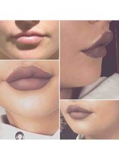 Lip Augmentation - Intrigue Cosmetic Clinic