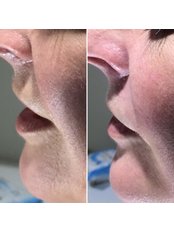 Nasolabial Folds Treatment - Intrigue Cosmetic Clinic