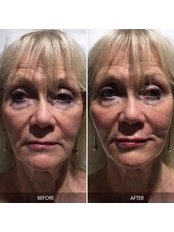 Cheek Augmentation - Intrigue Cosmetic Clinic