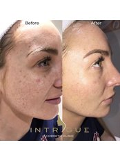 Acne Facial - Intrigue Cosmetic Clinic