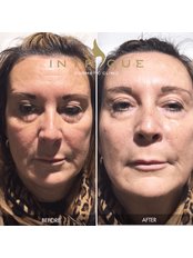 Non-Surgical Facelift - Intrigue Cosmetic Clinic