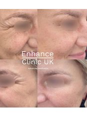 Treatment for Wrinkles - Enhance Clinic UK