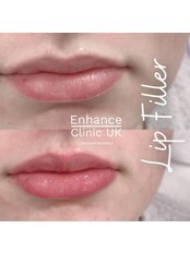 Lip Augmentation - Enhance Clinic UK