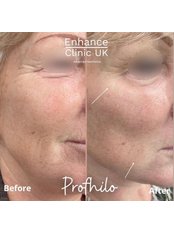 Profhilo® - Enhance Clinic UK