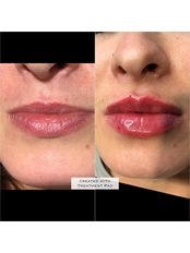 Lip Augmentation - Juvenology Clinic