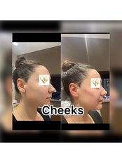 Cheek Augmentation - Juvenology Clinic
