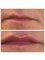 Northdowns Aesthetics - lovely lips 