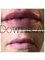 Northdowns Aesthetics - hot lips 
