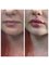 Northdowns Aesthetics - Gorgeous lips 