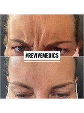 Treatment for Wrinkles - Revive Medics
