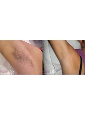 Laser hair removal in Kent - PureLite Non Surgical Aesthetics