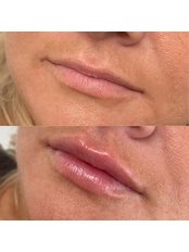 Lip Augmentation - Auream Aesthetics