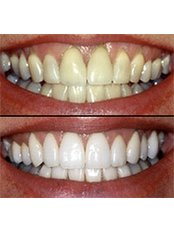 Teeth Whitening - Sparklem