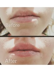 Lip Augmentation - Dermucare