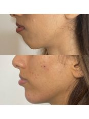 Chin Augmentation - Viva Skin Clinics