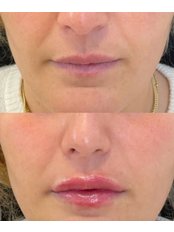 Lip Augmentation - Viva Skin Clinics